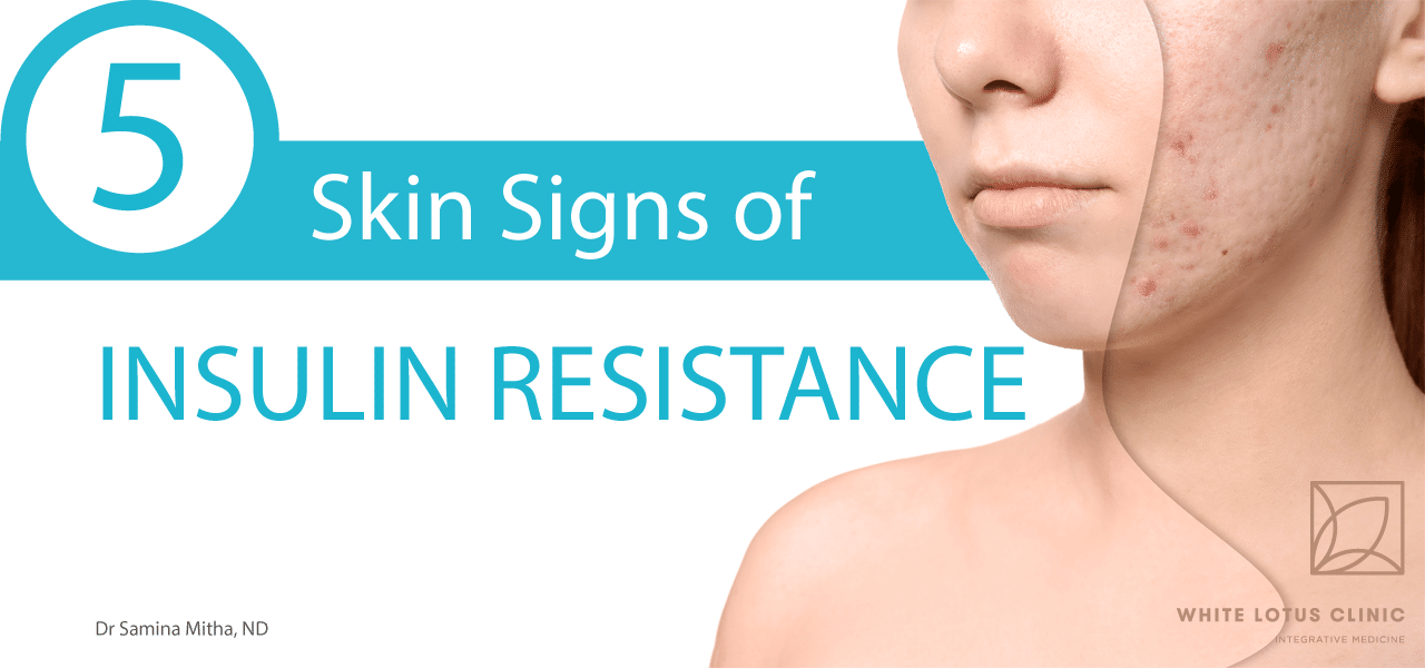 5 Skin Signs of Insulin Resistance