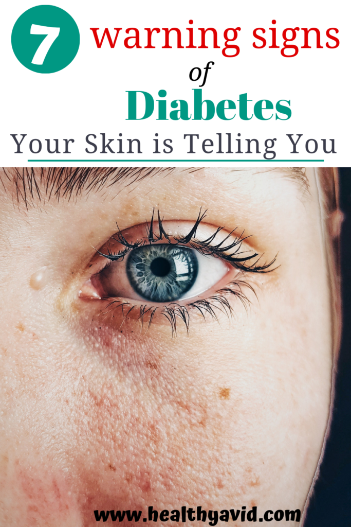 7 Warning Signs Of Diabetes Your Skin Is Telling You ...