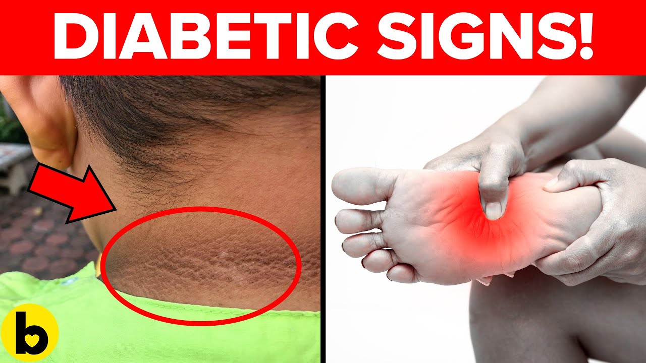 8 Signs That You Didnât Know Could Mean You Are Diabetic ...