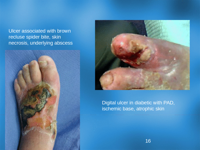 Advances in healing of diabetic foot ulcers