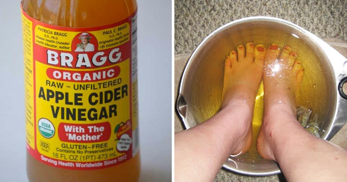 Can Diabetics Soak Their Feet In Apple Cider Vinegar