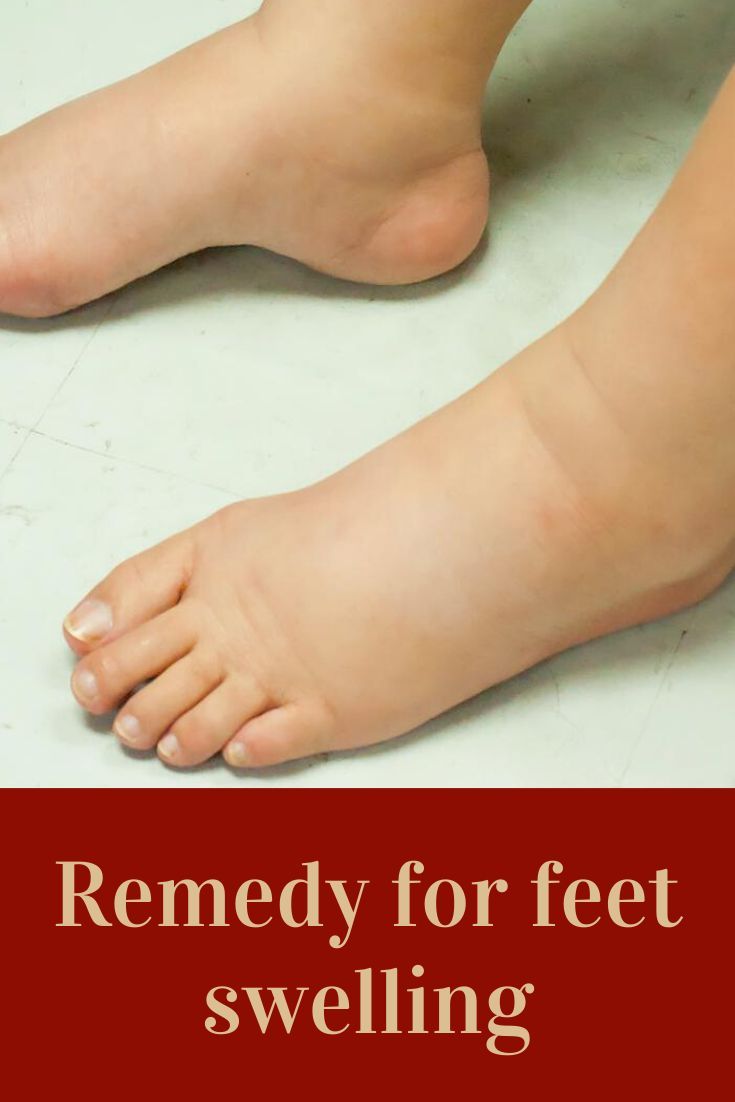 Can Feet Swelling Be A Sign Of Diabetes