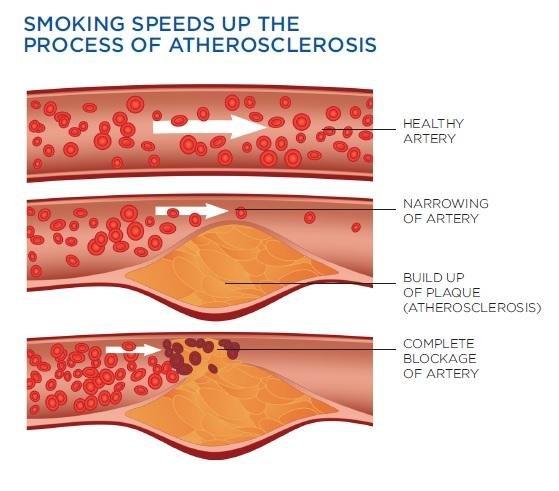 Can High Blood Sugar Levels Cause A Stroke?