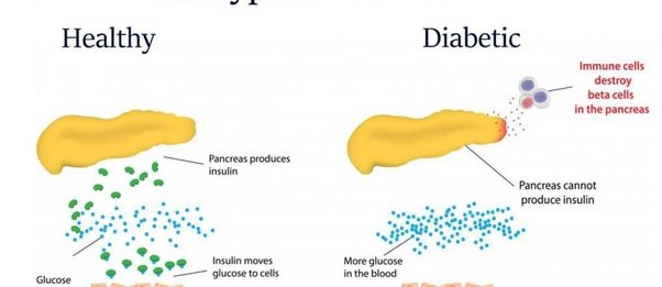 Can you get rid of type 1 diabetes?