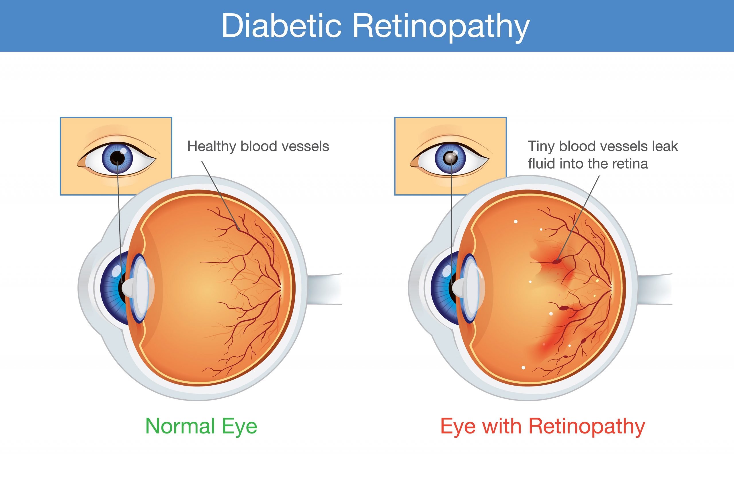Causes and Treatments for Diabetic Retinopathy