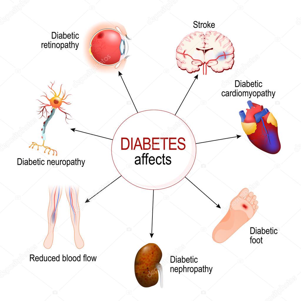 Diabetes Affects Complications Diabetes Mellitus Nephropathy Diabetic ...