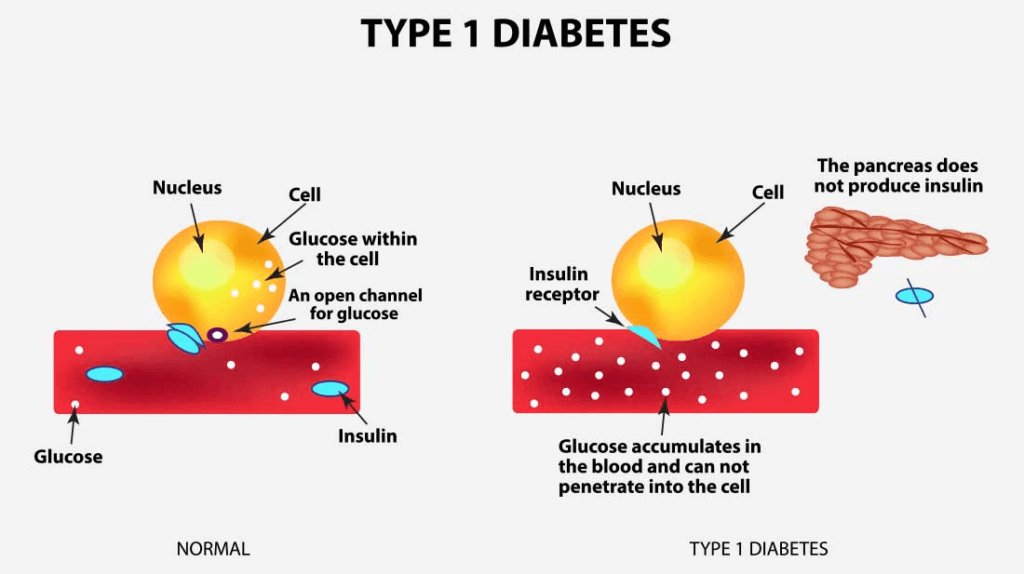 Diabetes Causes : Symptoms,Types, And Treatment