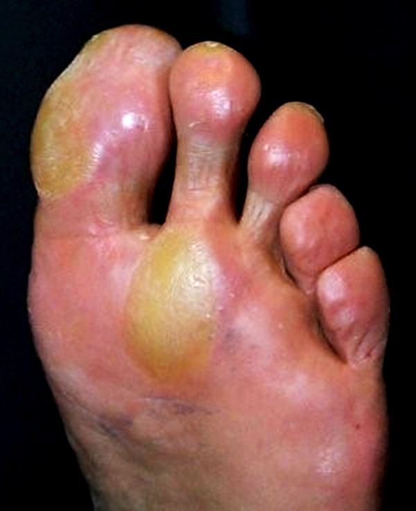 Diabetic Blisters On Legs Images