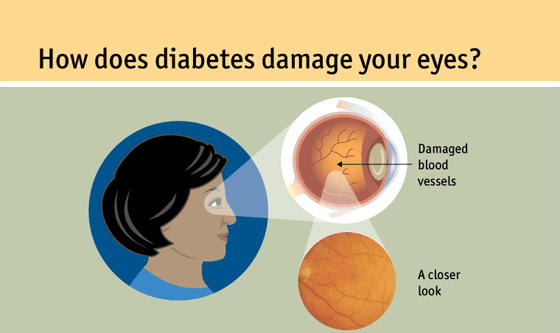 Diabetic Eye Disease: A Self