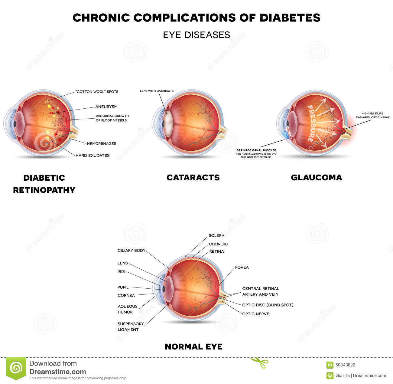 Diabetic Eye Diseases stock vector. Illustration of ...