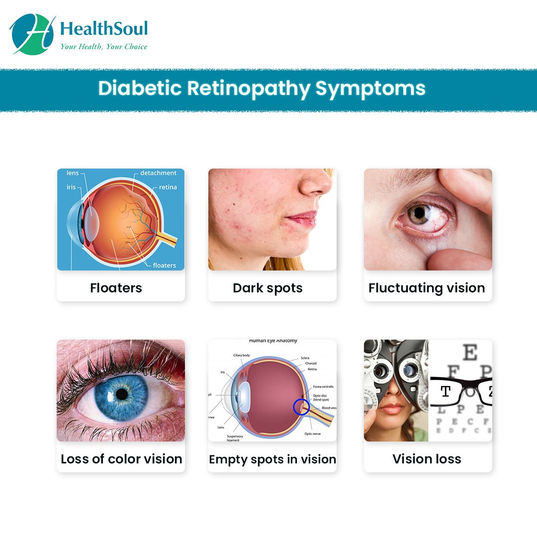 Diabetic Retinopathy: Symptoms, Diagnosis, and Treatment ...