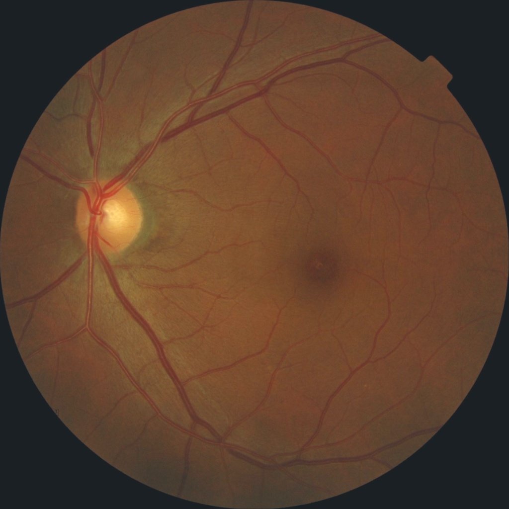 Diagnosing Diabetic Retinopathy with Deep Learning