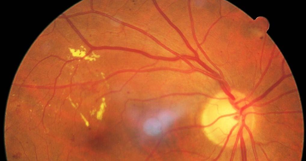 Eyedolatry: Picture Review of Diabetic Retinopathy