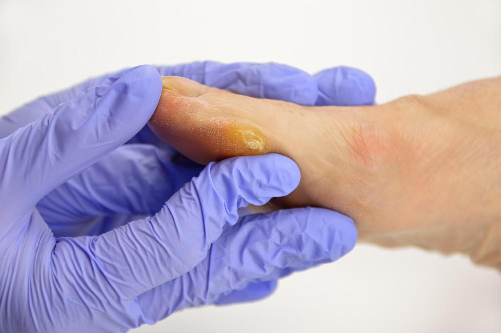 How Diabetes Affects Your Feet: Michfoot Surgeons PC: Podiatry