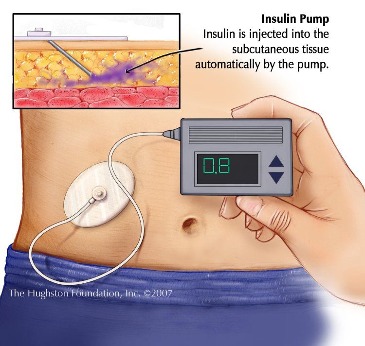 How does an insulin pump work?: #diabetes #diabetic #T1D # ...