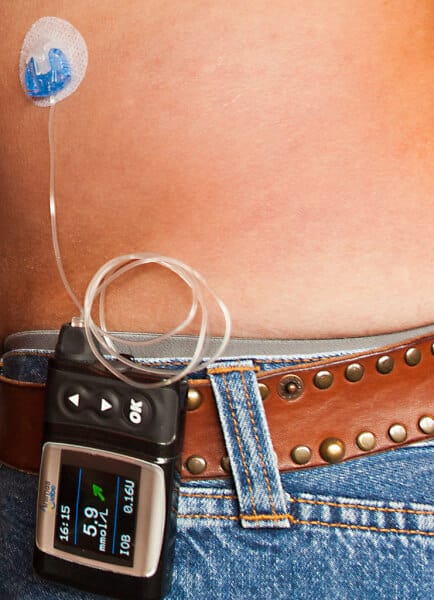 How Much Does Insulin Pump Cost In 2020?