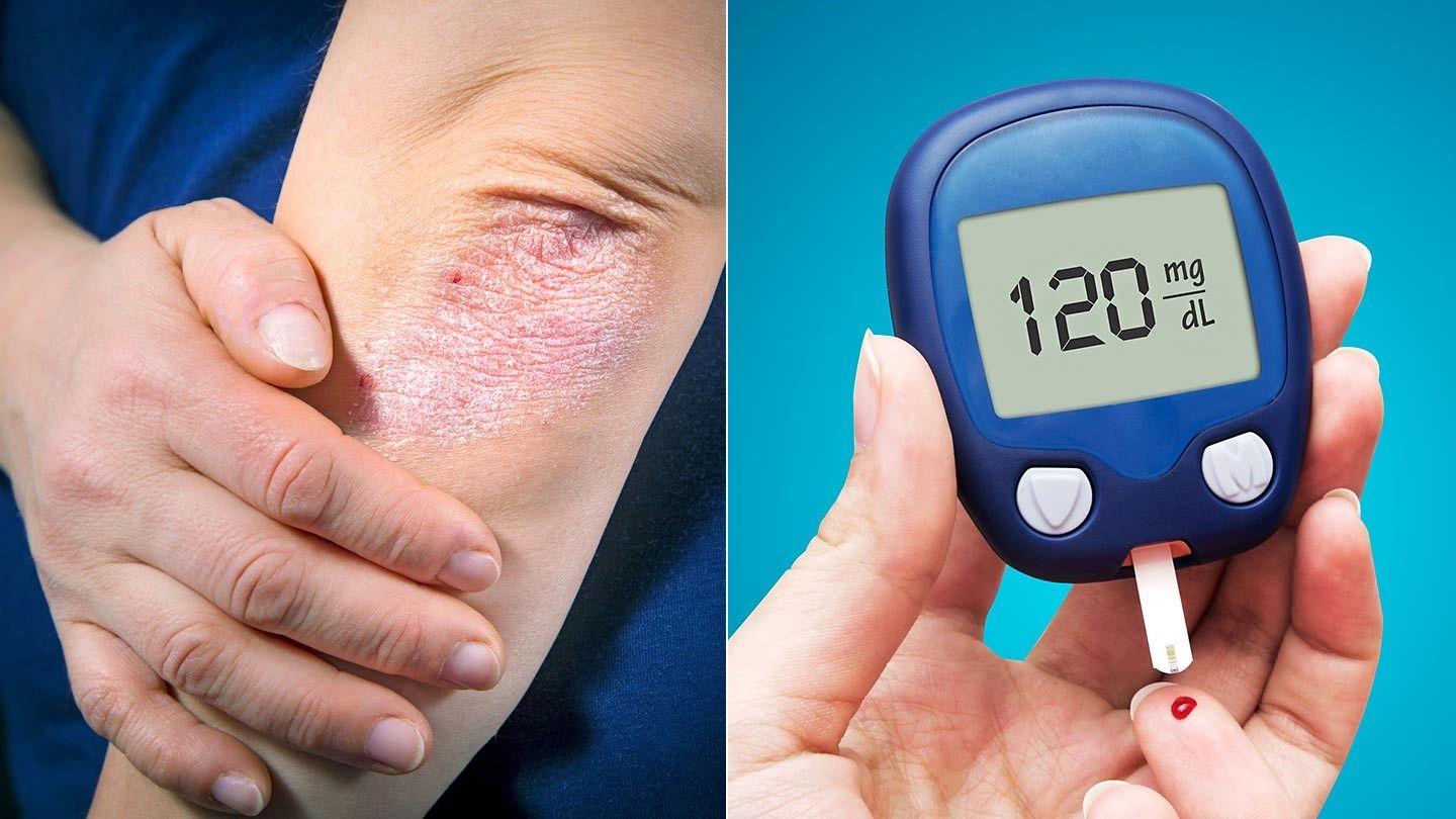 How Psoriasis and Type 2 Diabetes May Be Linked