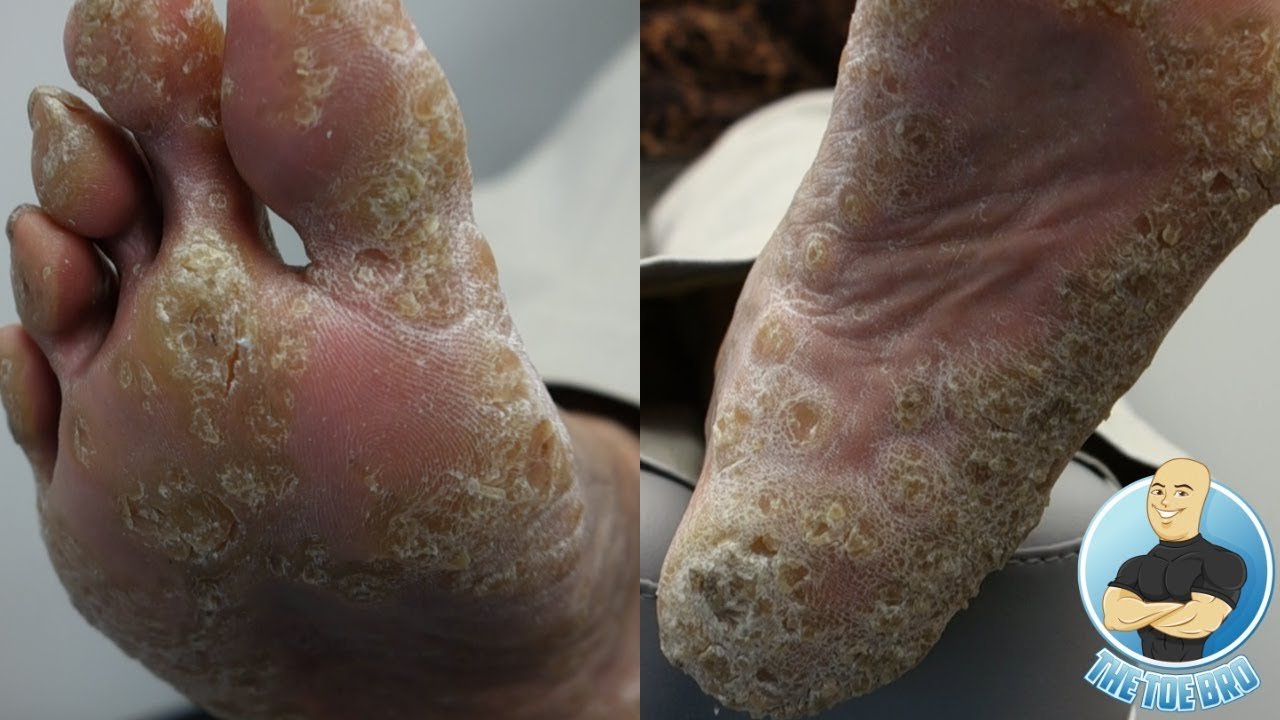 How To Remove Calluses From Diabetic Feet