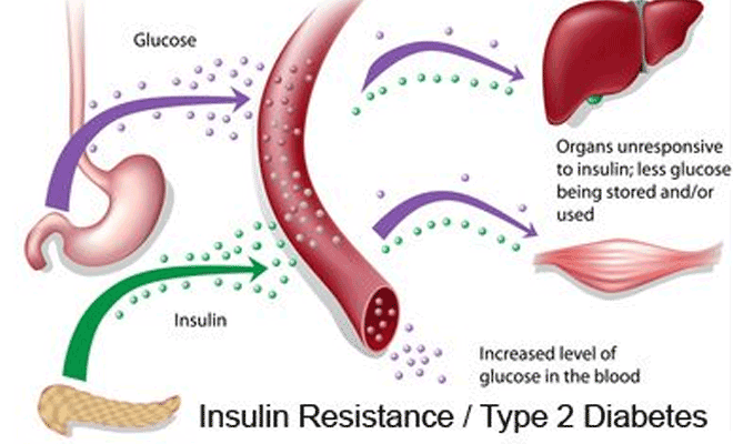 Insulin Resistance: Causes, Symptoms, Diagnosis &  Treatment Â» How To Relief