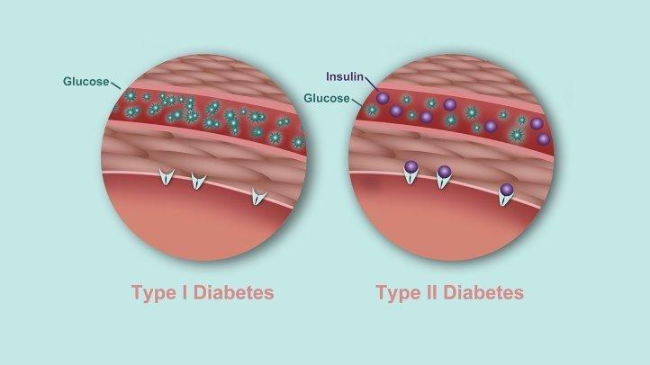 Is Type 2 Diabetes Worse Than Type 1