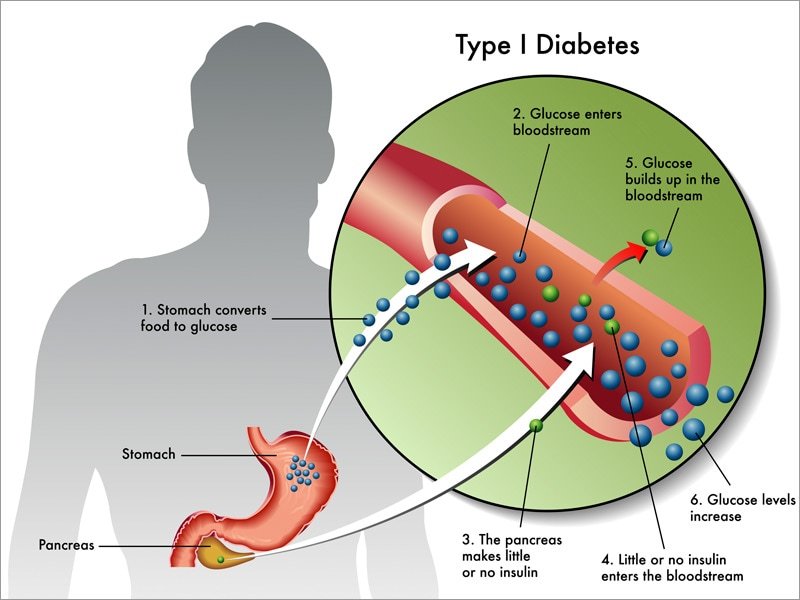 Liraglutide Benefits Patients With Type 1 Diabetes