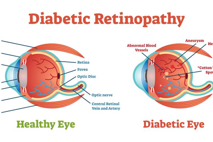 May is Healthy Vision Month, See How Diabetes Affects Your Eyesight ...