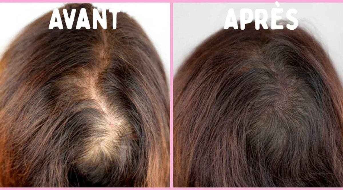 Say goodbye to hair loss and grow it back in a week with ...