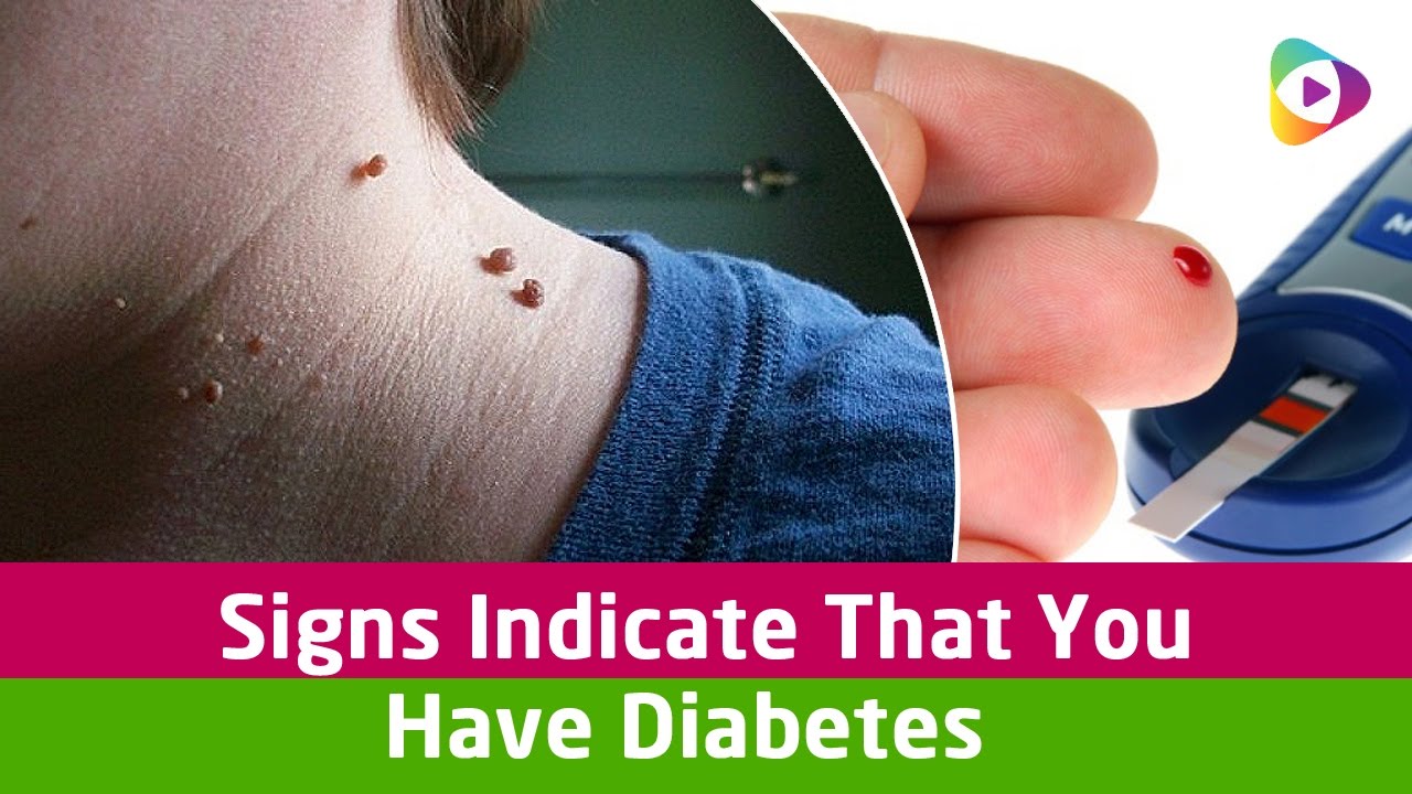 Signs Indicate That You Have Diabetes!