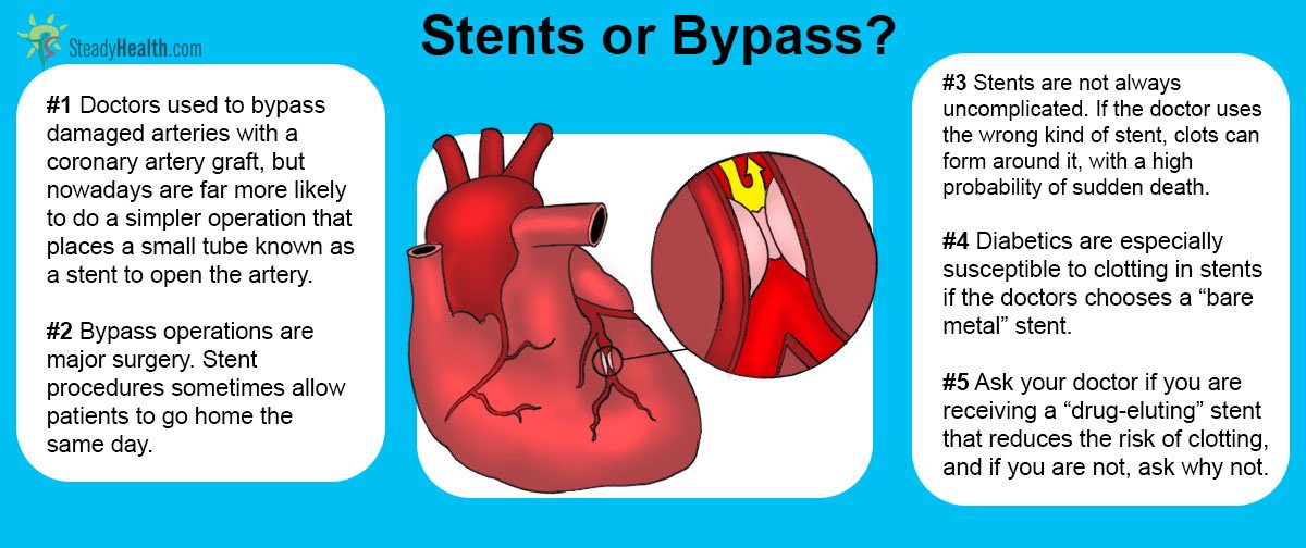Stents Or Bypass: Which Is Safer For Diabetics ...