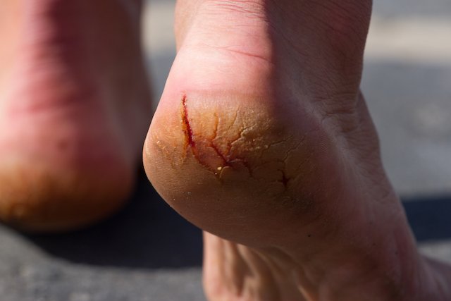 Suffering from ongoing cracked heels?
