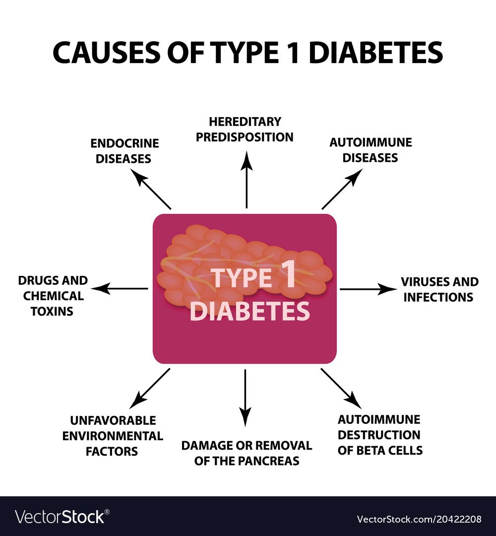The causes of diabetes type 1 infographics Vector Image