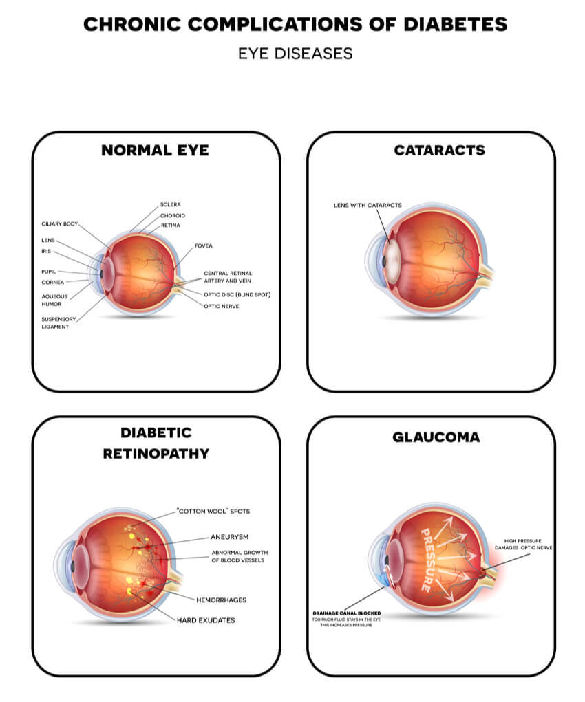 The Ins And Outs of Diabetic Eye Disease
