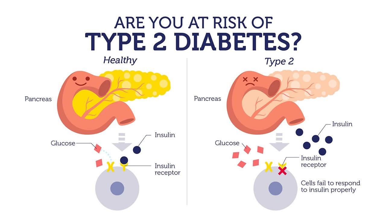The rising epidemic of Type 2 diabetes in children and ...