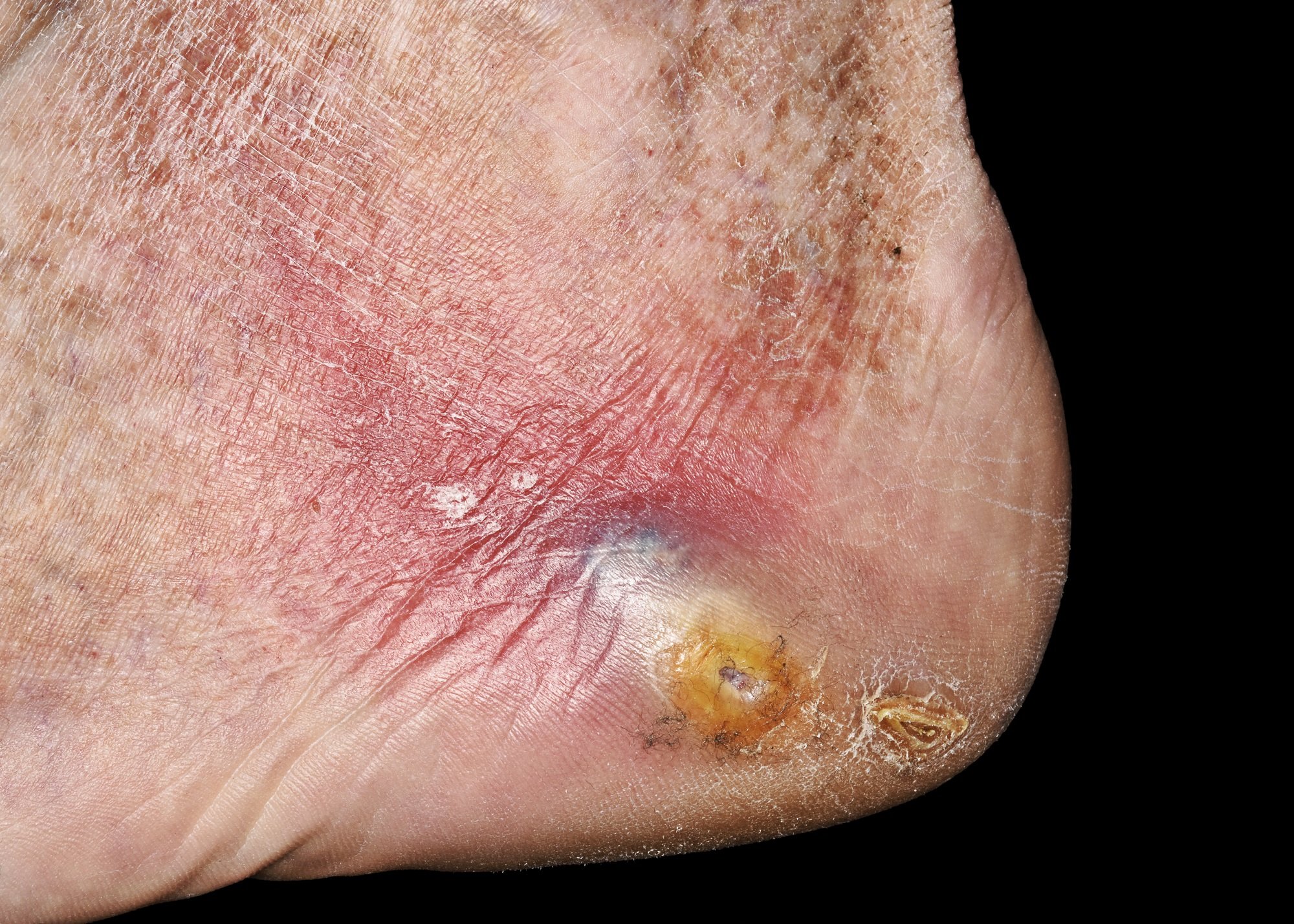 Treatment of Refractory Diabetic Foot Ulcers Improved With ...