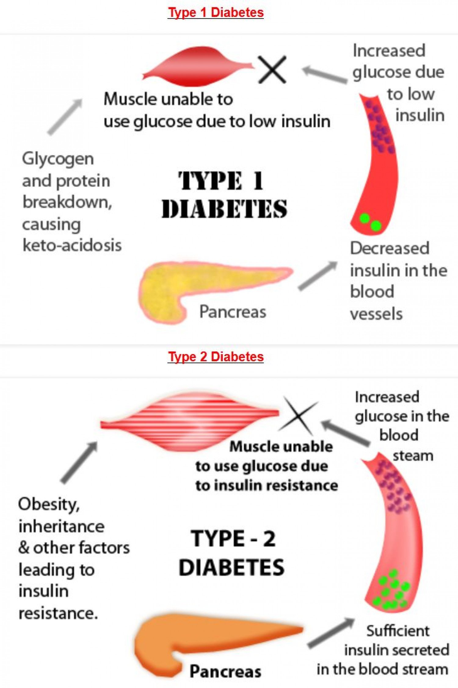 Type 1 diabetes and male fertility, type 1 vs type 2 diabetes which is ...