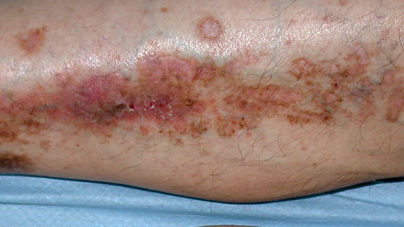 Type 2 Diabetes and Skin: Pictures, Dermopathy, Infections ...