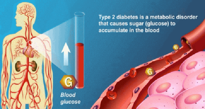 Type 2 Diabetes Mellitus Basics