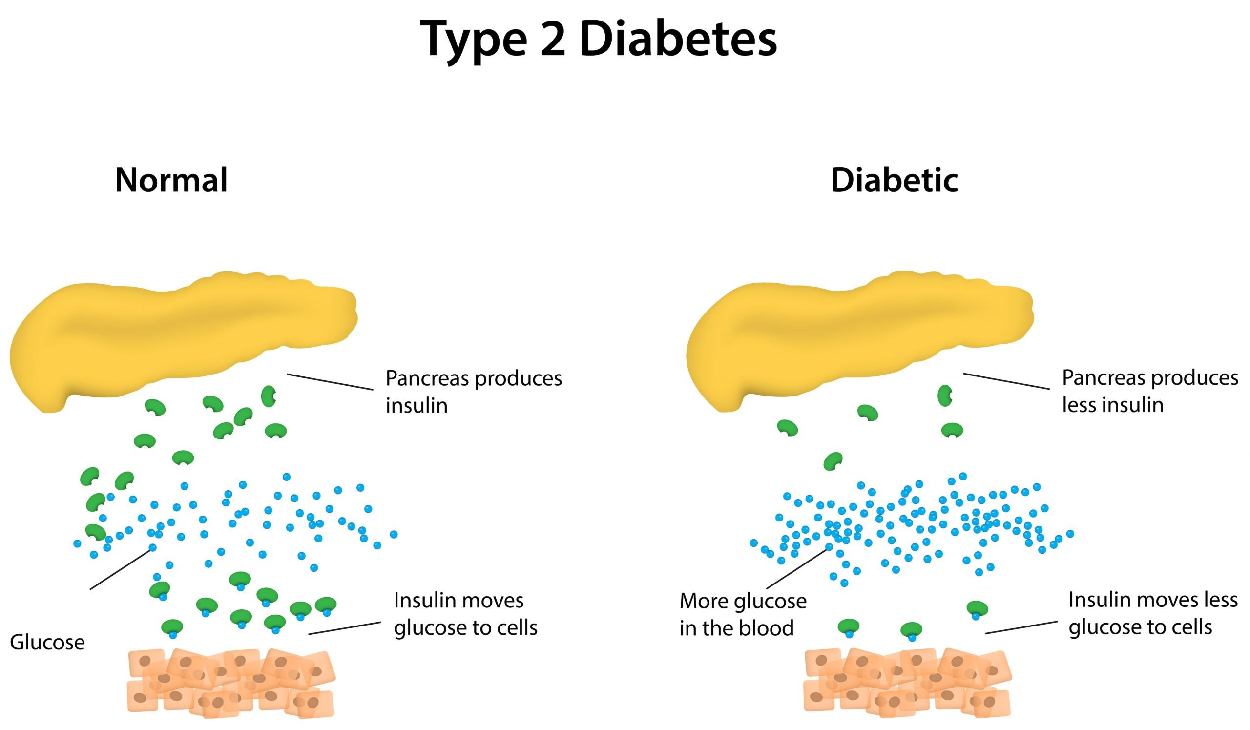 Type 2 Diabetes: Metabolomics Reveals Lipid Metabolism Dysregulation