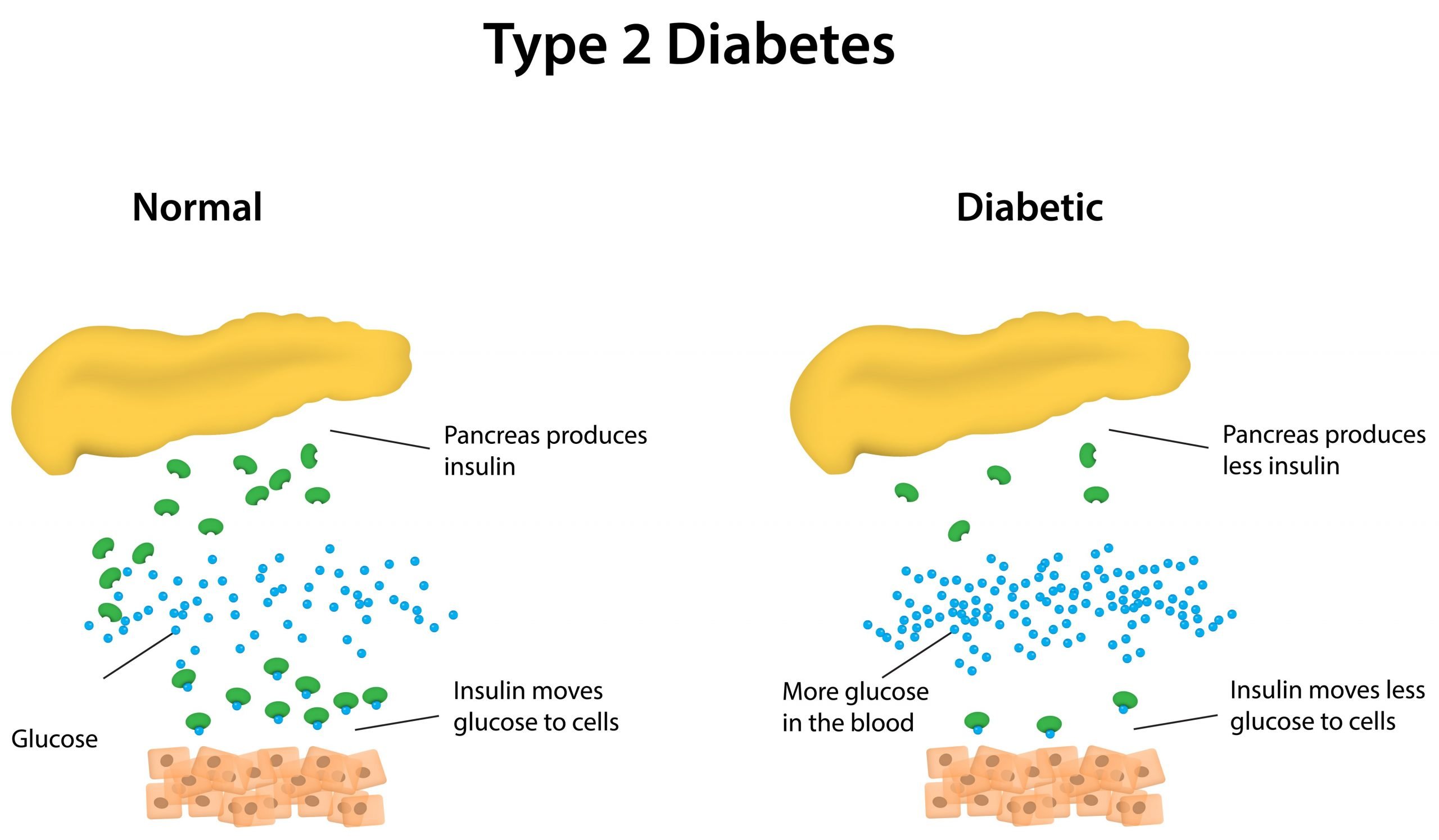 Type 2 Diabetes: Metabolomics Reveals Lipid Metabolism ...