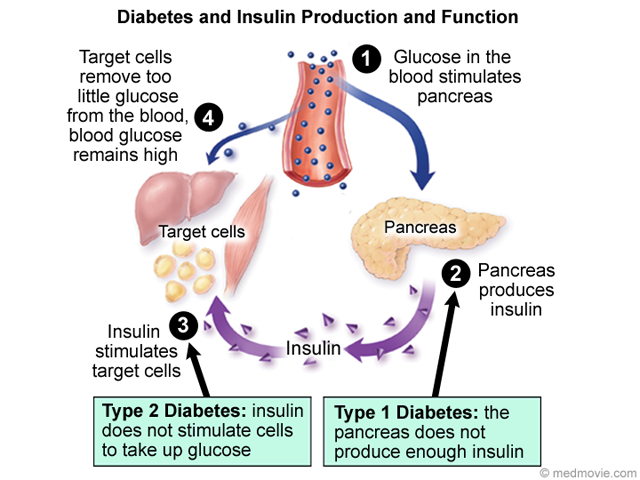 Types of Diabetes