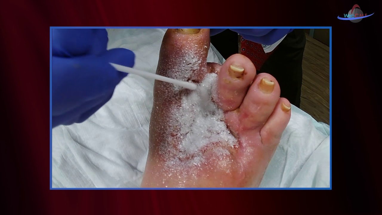 WCW: Applying Altrazeal to a Post Surgical Diabetic Foot ...