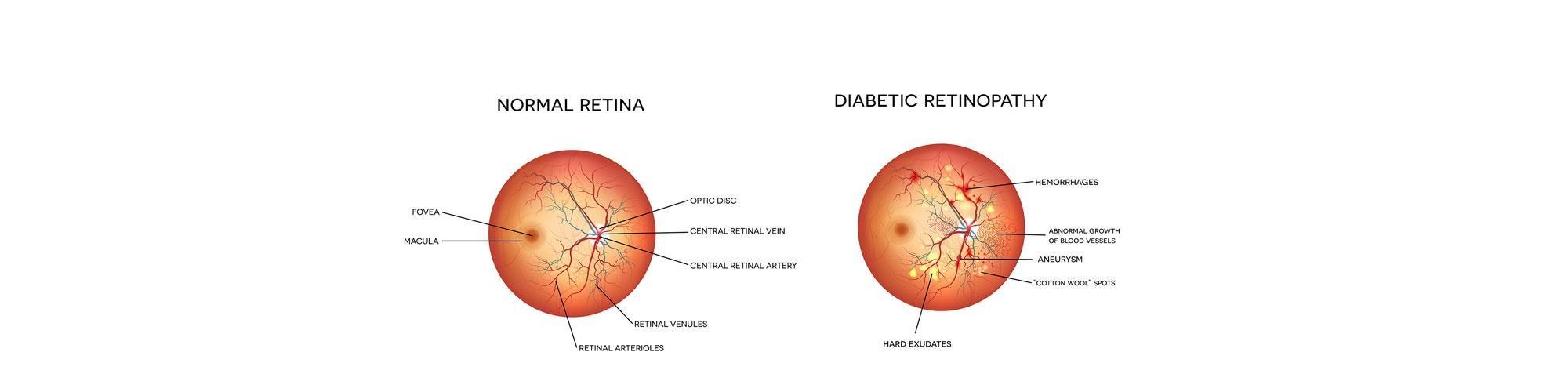 What Are The Four Stages Of Diabetic Retinopathy ...