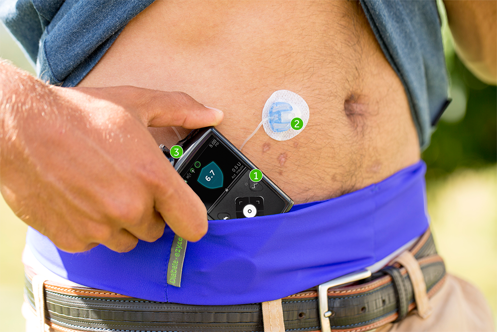 What is Insulin Pump Therapy?